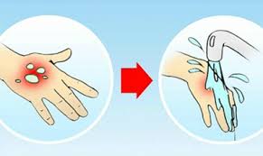 bỏng nước sôi sa