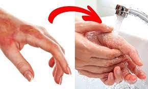 bỏng nước sôi sa